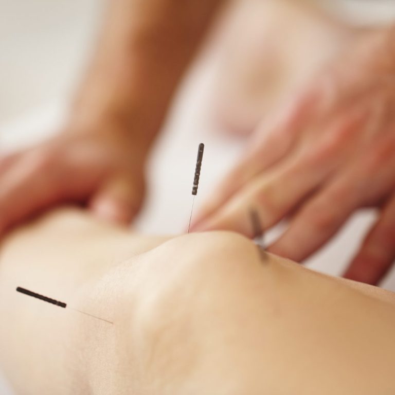 Acupuncture in La Zenia